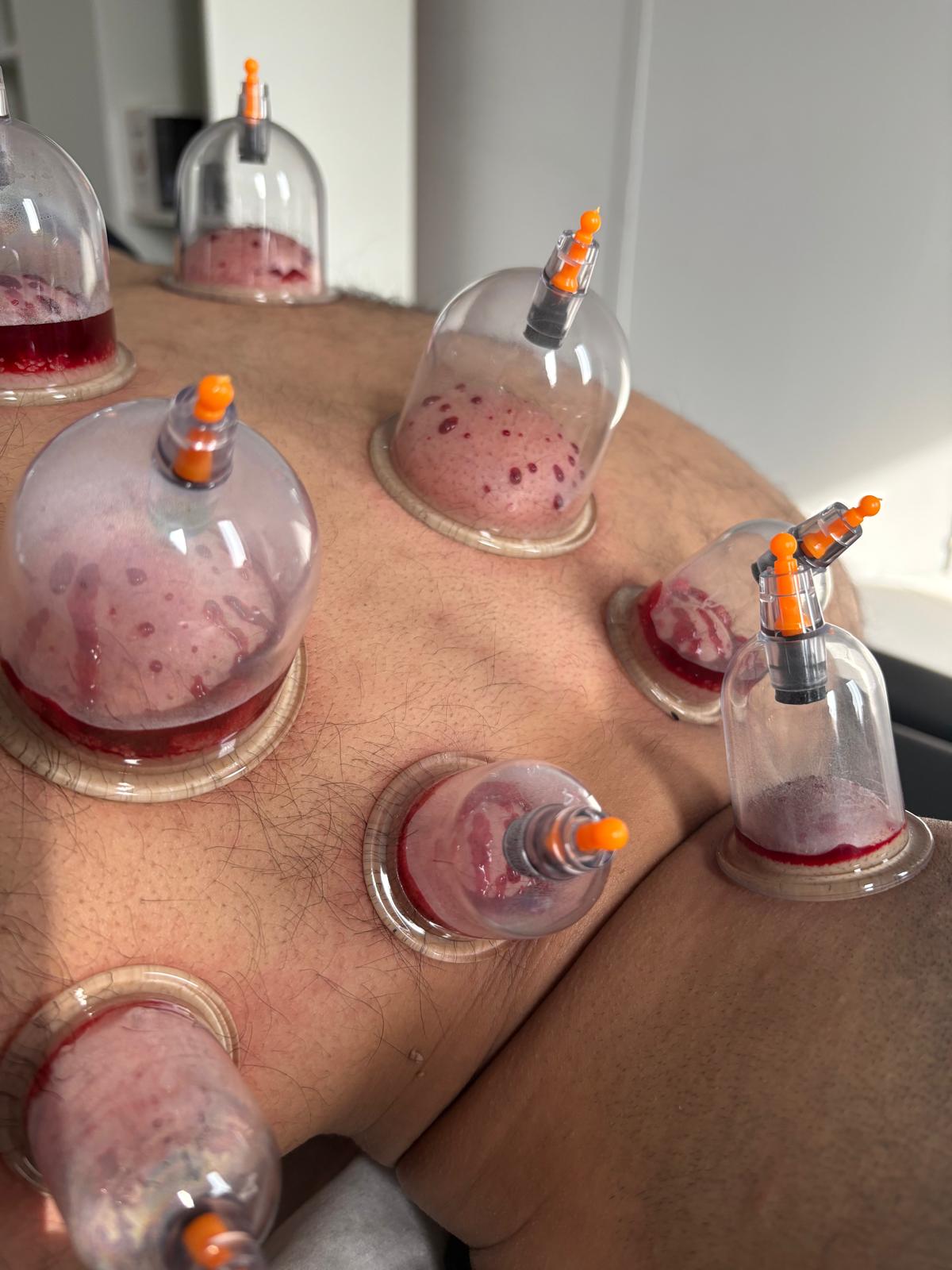 Wet Cupping (Hijama)